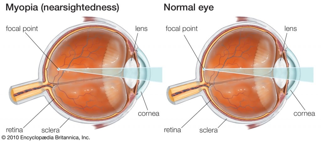 mi a szenilis myopia