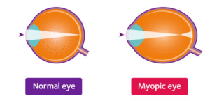 An example of Myopia eyes